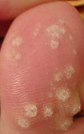 Warts on the toe